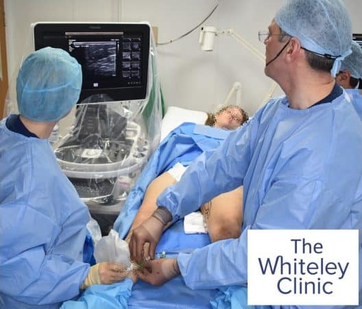 Prof Mark Whiteley showing how to close incompetent perforating veins with Endovenous Microwave Ablation using the TRLOP technique