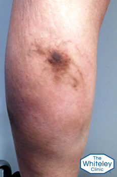 Haemosiderin brown staning due to old phlebitis from varicose veins arising from pelvis crop