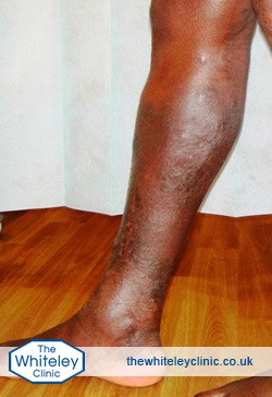 Phlebitis in black skin