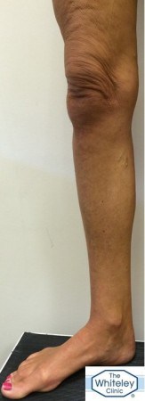 Right leg showing small varicose veins only despite Great Saphenous Vein reflux