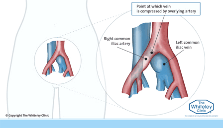 Diagram of classic May Thurner Syndrome - Left common iliac vein compressed by the right common iliac artery