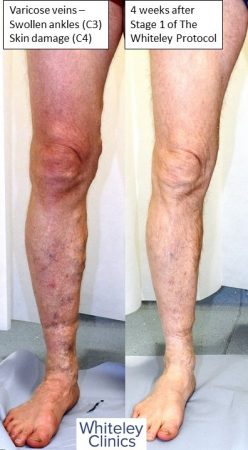Large varicose veins swollen ankles and haemosiderin skin damage cured by The Whiteley Protocol local anaesthetic endovenous surgery - anterior leg