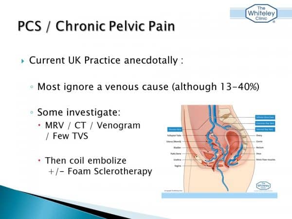 Chronic pelvic pain and pelvic congestion syndrome talk by Mark Whiteley - American Venous Forum Feb 2017