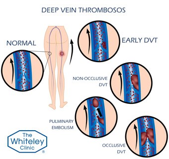 Diagram showing formation of DVT