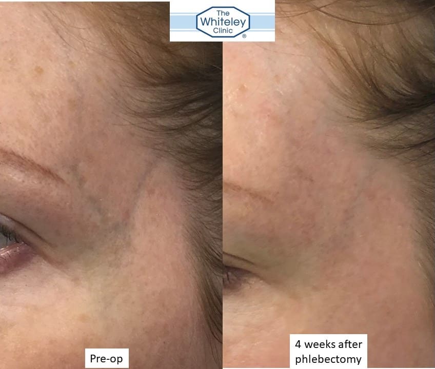 removal of veins on temple - remove facial veins - whiteley clinic dec 2017