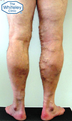 Severe Varicose Veins in Male - CEAP-C2