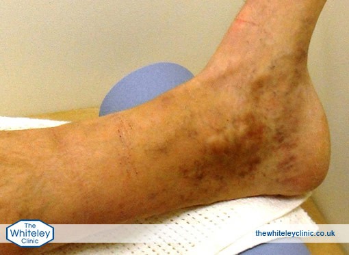 Haemosiderin shown in an ankle as a brown stain