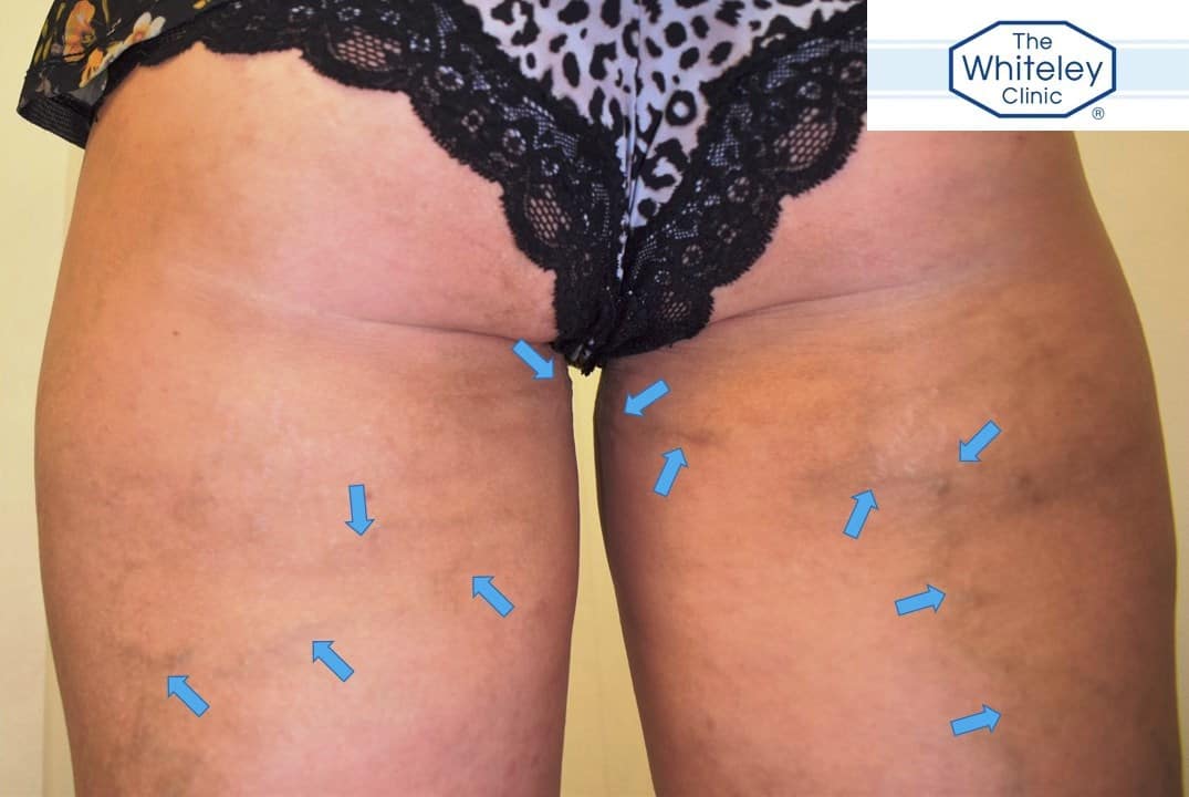 Varicose veins on backs of thighs - classic of pelvic varicose veins causing leg veins - marked with arrows