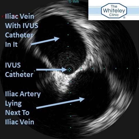 IVUS (Intravascular Ultrasound Picture) of the iliac vein in the pelvis and showing the artery next to it