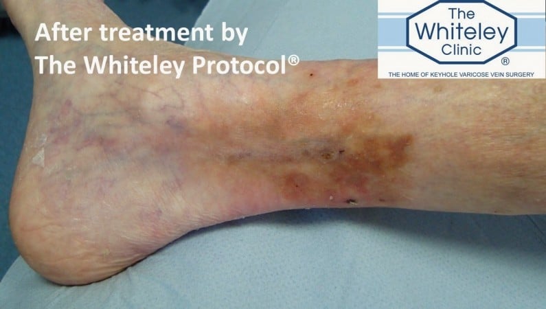 Venous leg ulcer cured after treatment