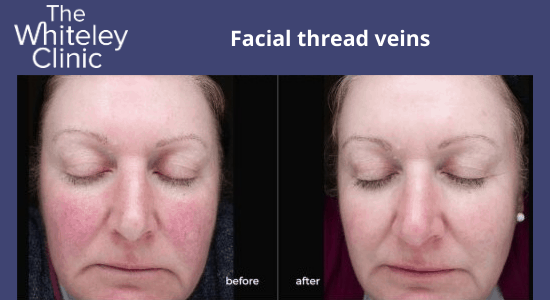 Facial thread veins