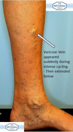 Varicose vein caused by intense cycling - perforator incompetence - The Whiteley Clinic Nov 2017