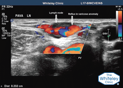 Duplex ultrasound showing PAVA (primary avalvular varicose anomalies)