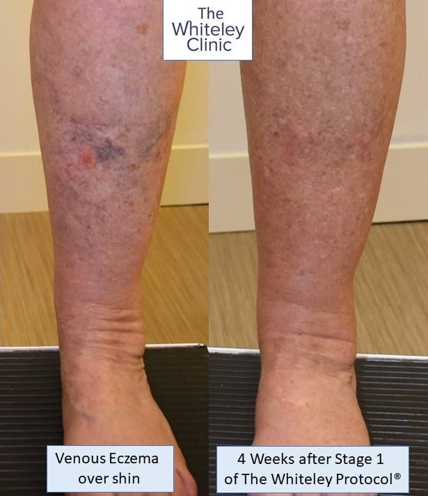 You are all awesome &ndash; Venous Eczema Cured by Whiteley Protocol