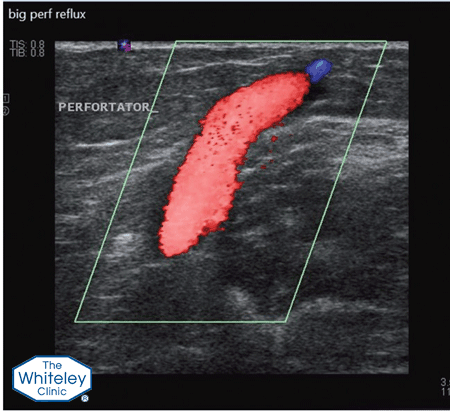 Duplex ultrasound scan showing blood refluxing back out of the deep veins