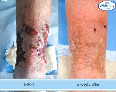 Leg ulcer before and after treatment