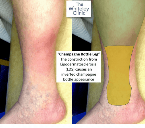 Champagne bottle leg due to lipodermatosclerosis