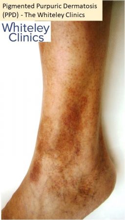 Pigmented purpuric dermatosis PPD pigmented dermatosis left ankle lateral - The Whiteley Clinic