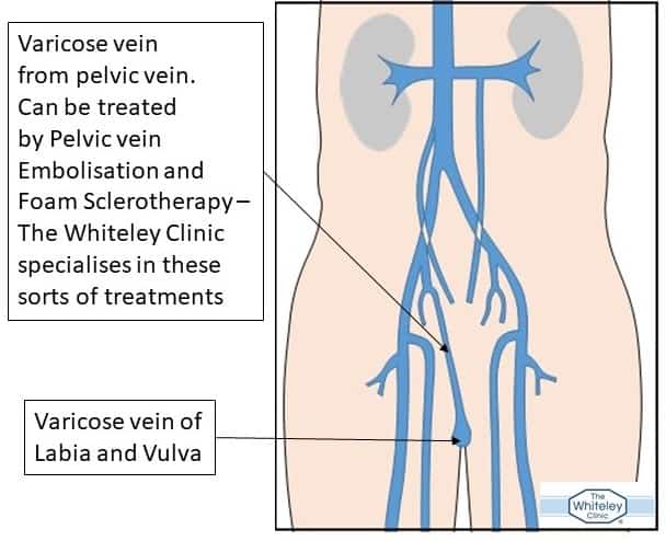 Varicose vein of vulva and labia misdiagnosed as cancer of vulva