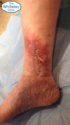 Healing venous leg ulcer after endovenous surgery under local anaesthetic at The Whiteley Clinic