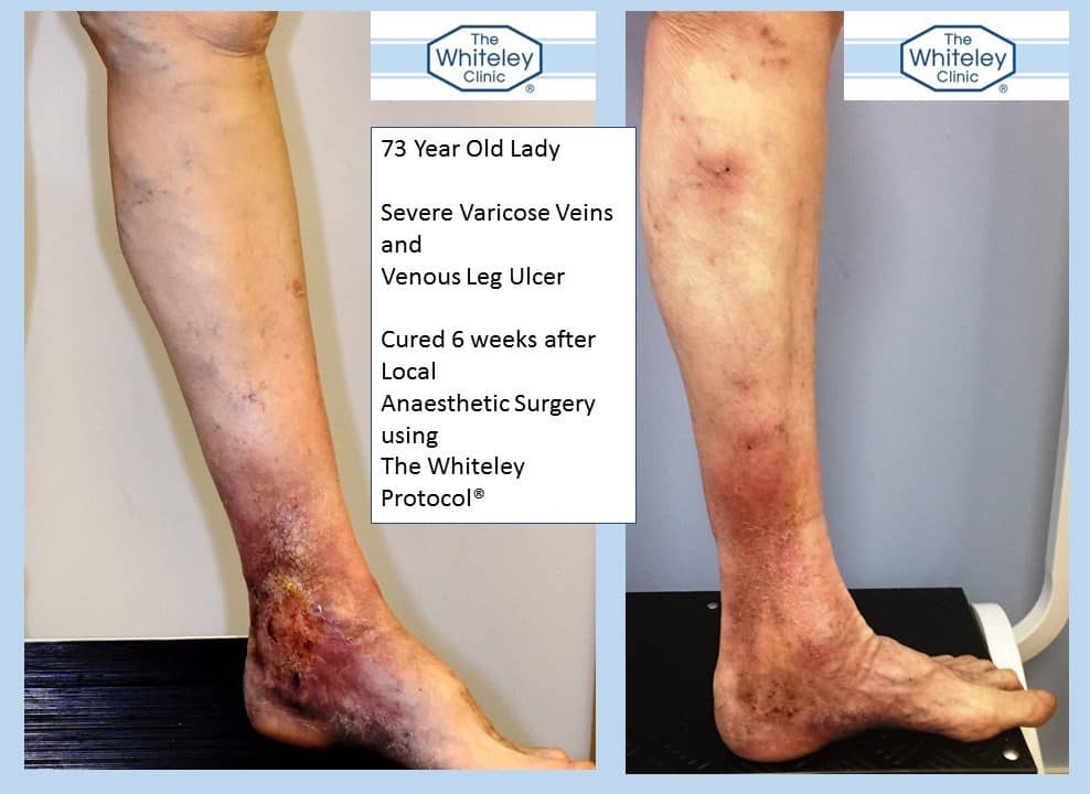 Varicose veins and venous leg ulcer cured in 6 weeks by local anaesthetic treatment using Whiteley Protocol
