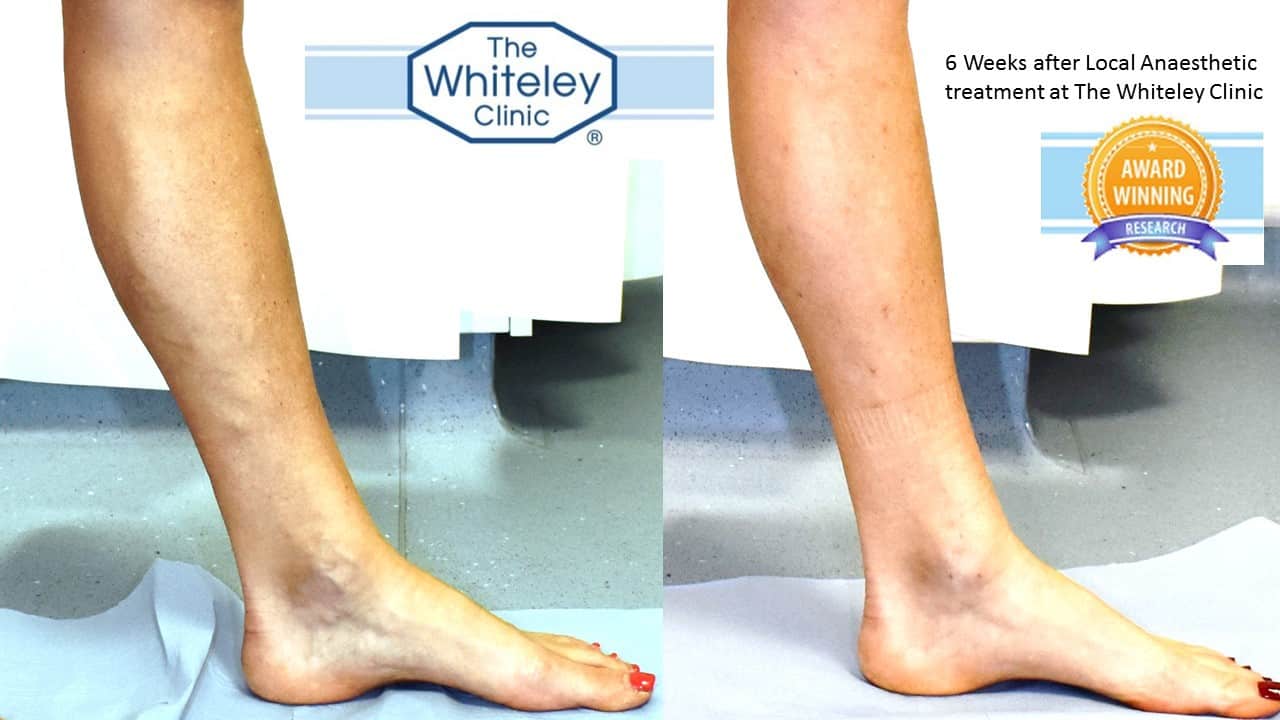 varicose veins before and after endovenous laser Whiteley Protocol