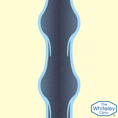 Failing vein valves causing venous reflux - a cause of varicose veins