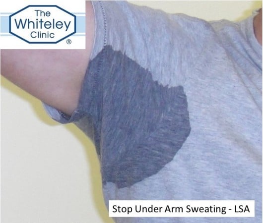 stop under arm sweating with Laser Sweat Ablation LSA using Whiteley LSA Cannula at The Whiteley Clinic