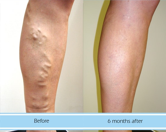 Results for varicose vein treatment