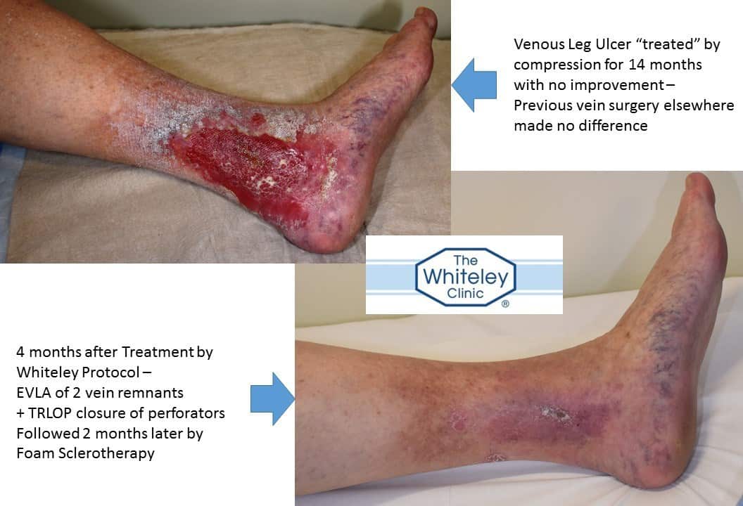 Venous Leg Ulcer cure in time for Christmas - after 14 months of compression bandaging with no effect, The Whiteley Protocol cured the ulcer in 4 months