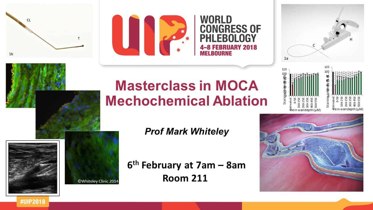 Masterclass on MOCA - Clarivein - with Prof Mark Whiteley - 6th Feb 2018