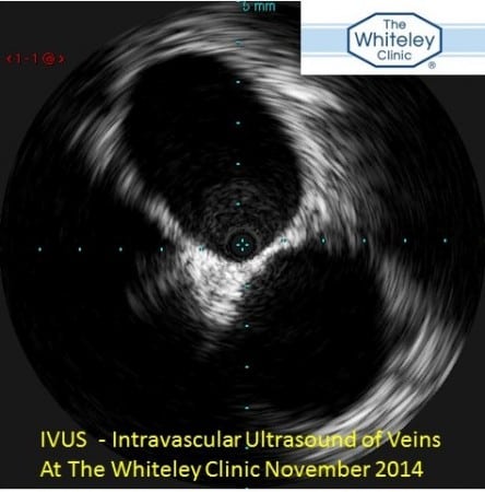 IVUS Intravascular Ultrasound For Varicose Vein Problems at The Whiteley Clinic November 2014