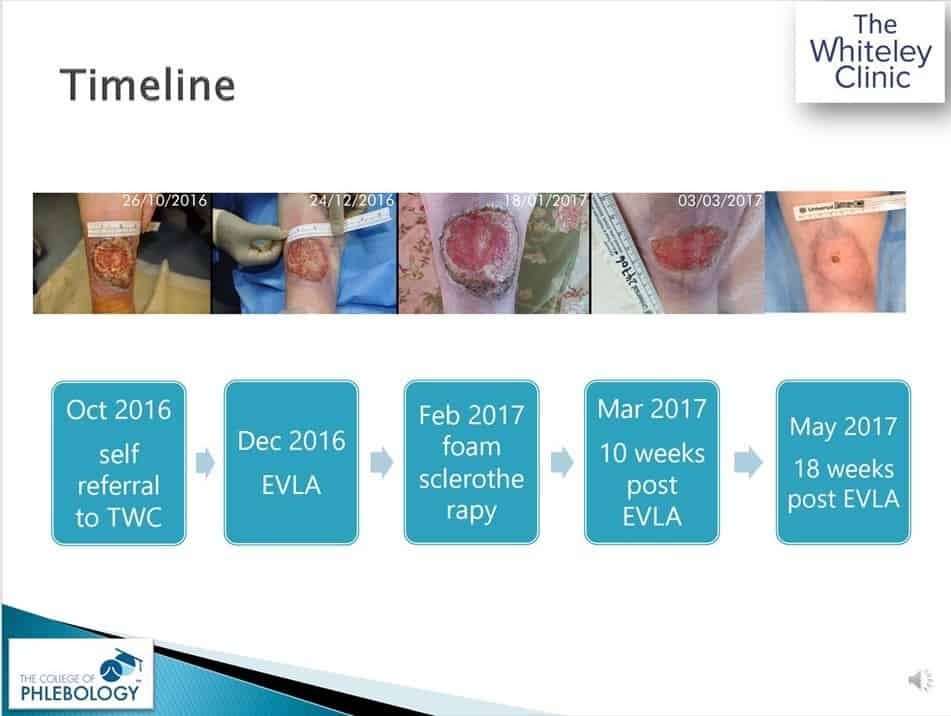 Curing Venous Leg Ulcers &ndash; Slide from lecture by Mark Whiteley online Wed 9 September 2020