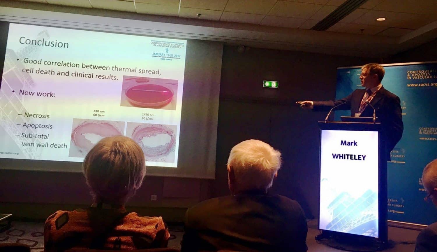 Prof Mark Whiteley lecturing in Paris at CACVS about endovenous laser EVLA Jan 2017