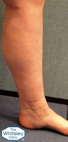 ankle oedema due to varicose veins showing imprint of socks - CEAP-C3