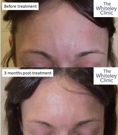 Veins on forehead removed at The Whiteley Clinic