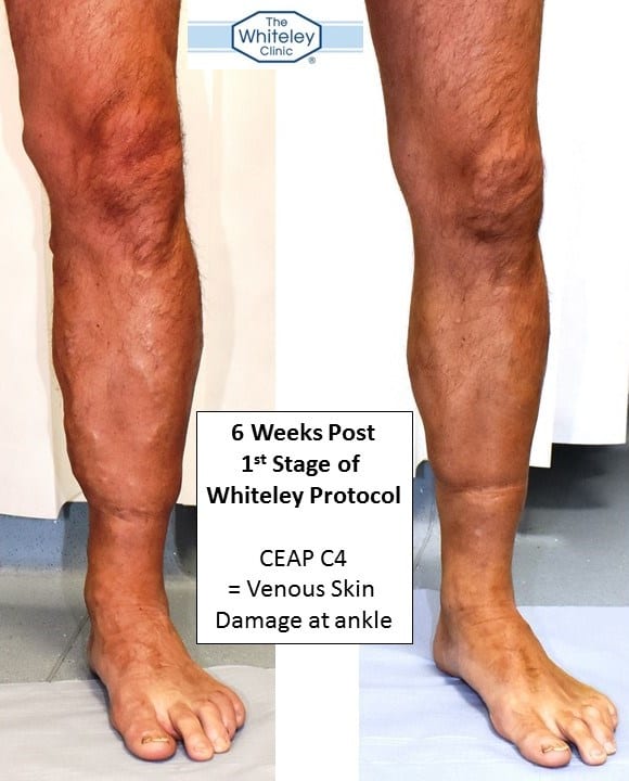 Varicose veins and venous skin damage at ankle (CEAP C4) - 6 weeks after only Stage 1 of The Whiteley Protocol