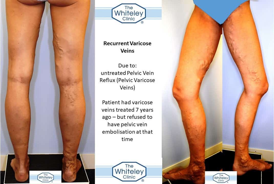 Recurrent varicose veins of legs due to pelvic veins not being treated due to patient choice