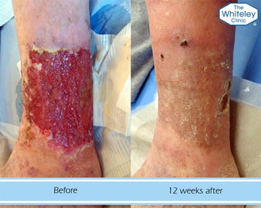 Leg ulcer before and after treatment