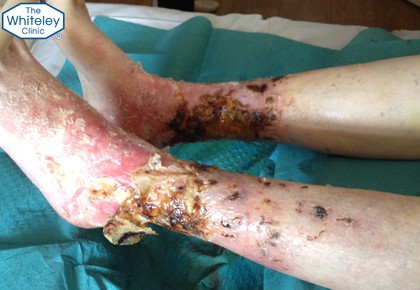 Severe venous leg ulcers drying out during elevation