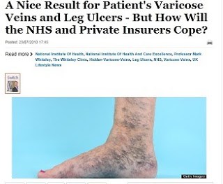 Huffington Post Article for NICE guidelines varicose veins