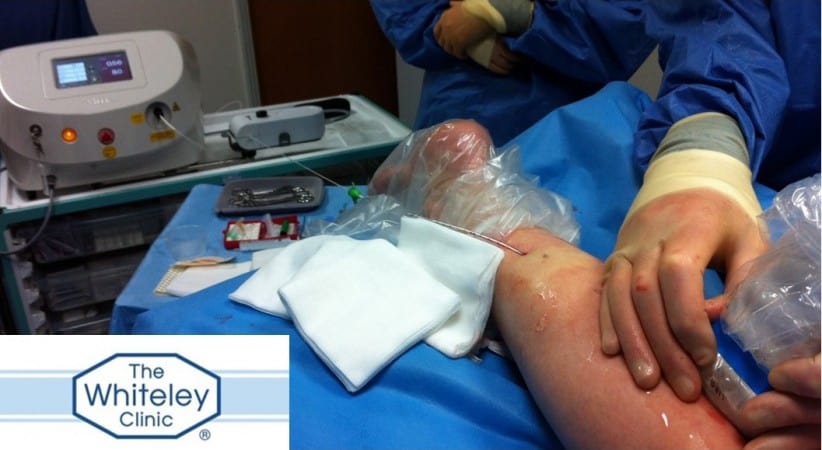 Another first in varicose vein treatment