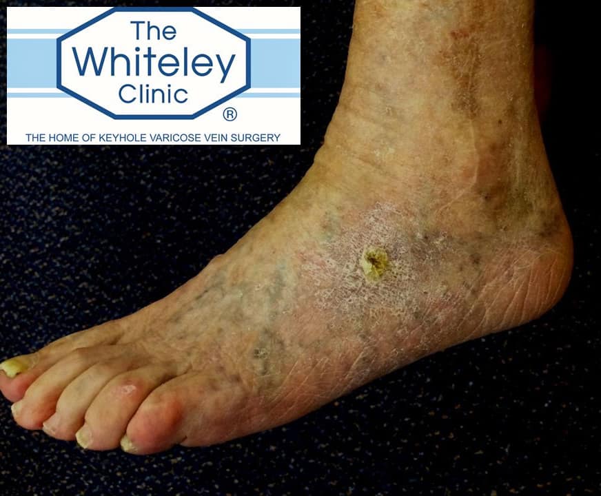 Venous foot ulcer - 4 weeks after treatment