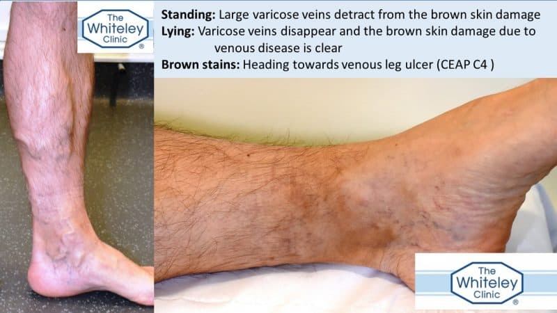 Venous skin damage hidden by big varicose veins