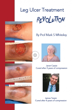 Leg Ulcer Treatment Revolution - by Prof Mark Whiteley