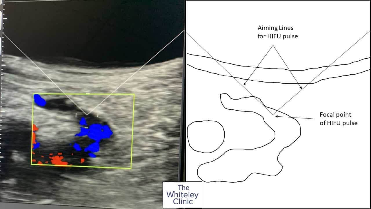 HIFU treatment of recurrent varicose veins &ndash; HIFU energy being aimed by ultrasound and on-screen guides