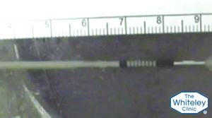 Experiment using a varicose vein RFiTT radiofrequency ablation catheter