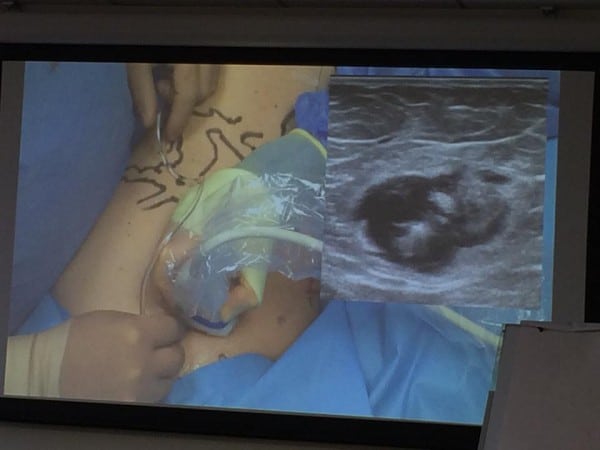 Prof Mark Whiteley teaching techniques for performing EVLT for varicose veins