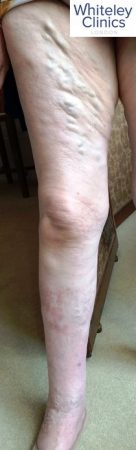 varicose veins, veins, vein health, bulging veins, aching legs