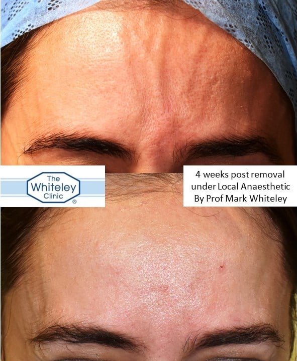 Forehead Veins before and after removed Prof Mark Whiteley of The Whiteley Clinic